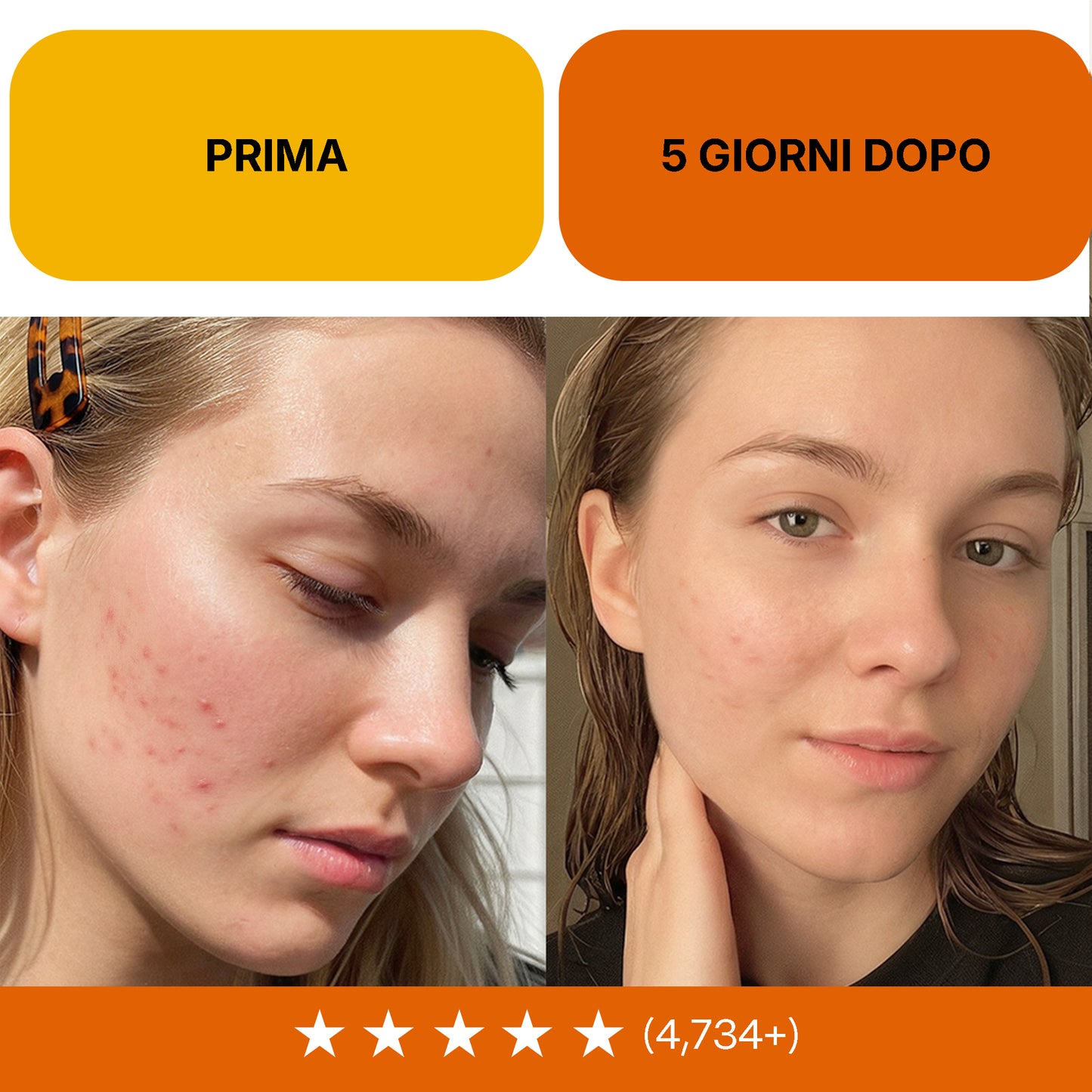 Routine Intensiva Anti-Acne