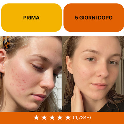 Routine Intensiva Anti-Acne